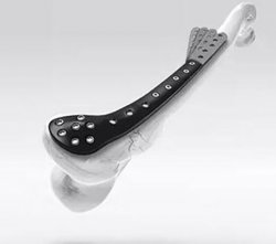 剖析碳纖維增強(qiáng)聚醚醚酮復(fù)合材料的植入性能